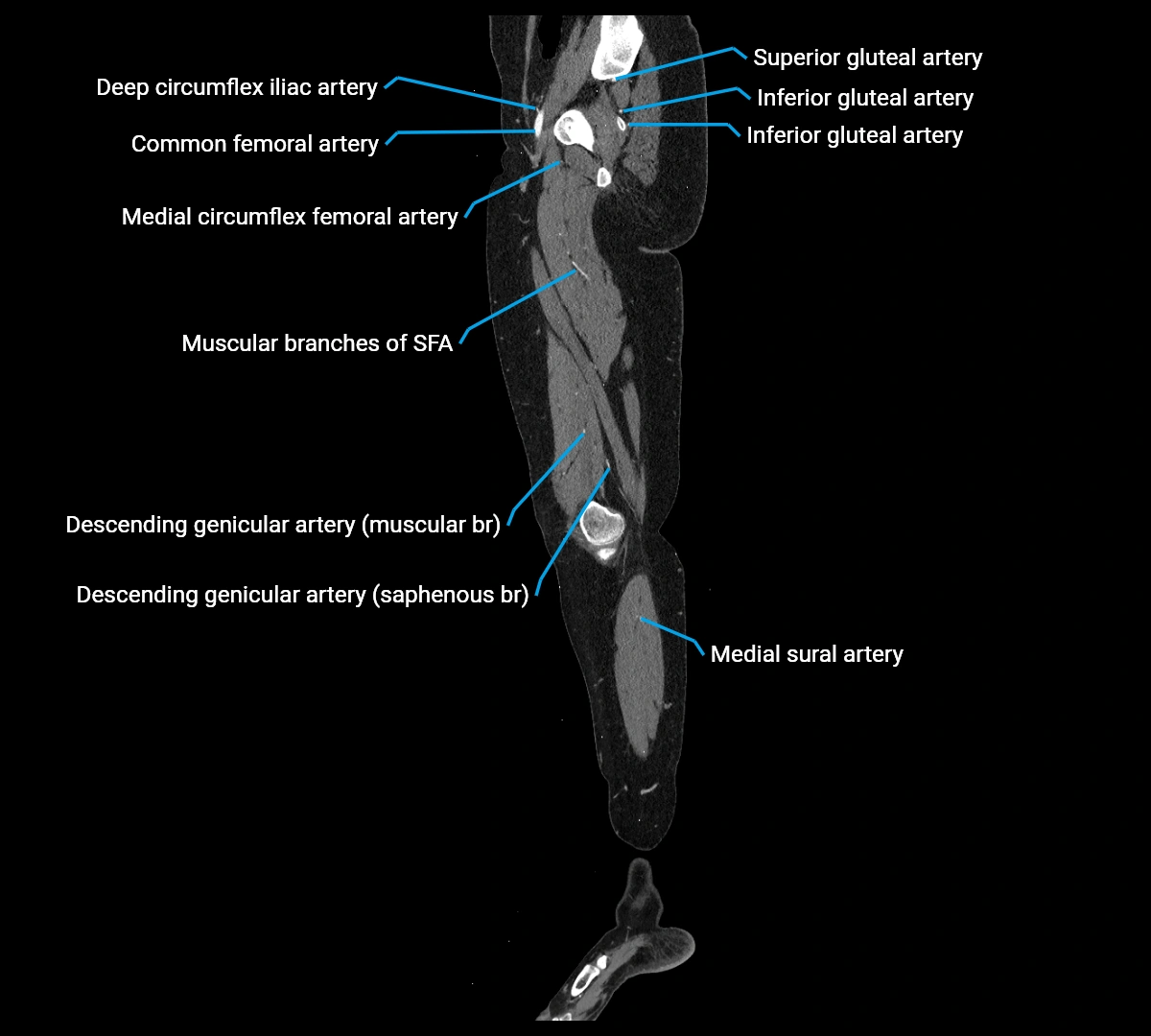 CTA lower limb sagittal cross sectional anatomy labelled image _25 (4).webp
